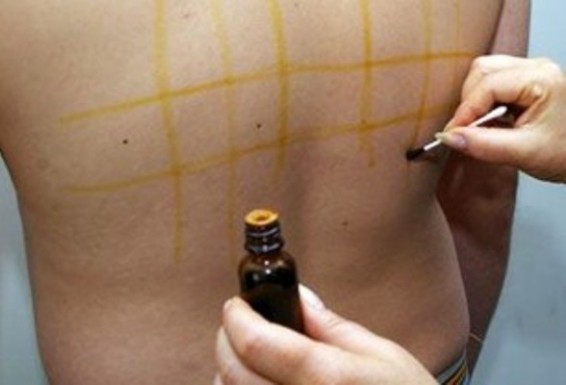 Յոդի ցանց. պարզ գծերի բուժիչ հատկությունները