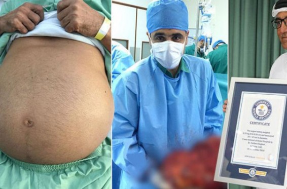 Դուբայի հիվանդանոցը գրանցվել է Գինեսի ռեկորդների գրքում՝ աշխարհի ամենամեծ երիկամների հեռացման համար